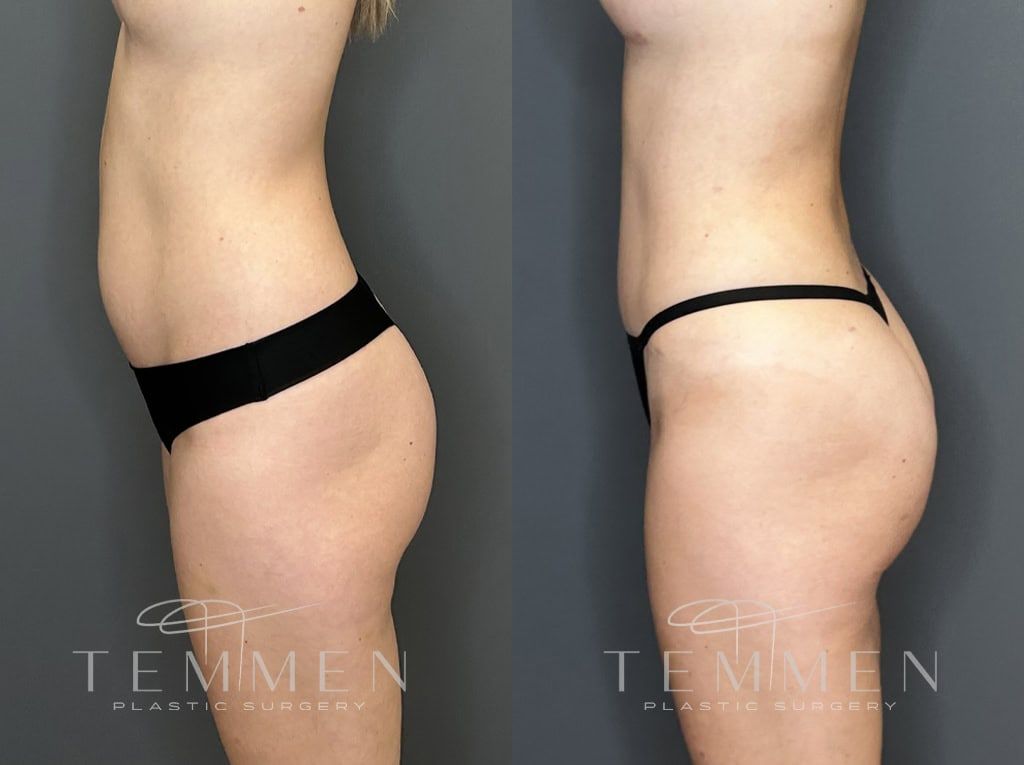 Tummy Tuck Before & After