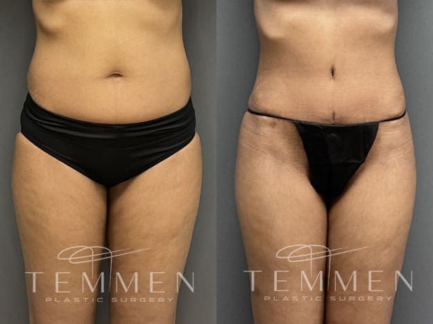 Tummy Tuck Before & After