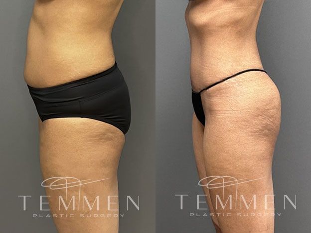 Tummy Tuck Before & After