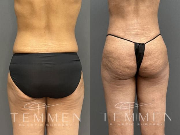 Tummy Tuck Before & After