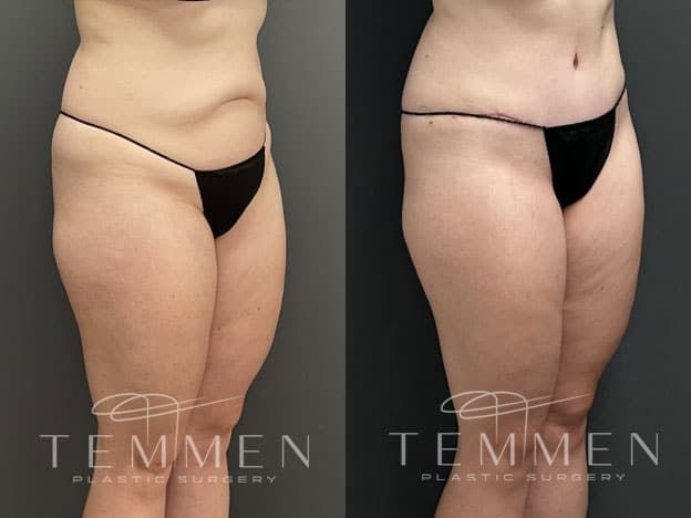 Tummy Tuck Before & After
