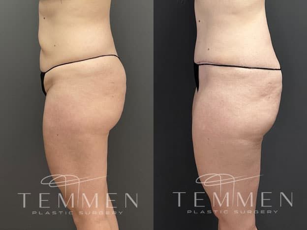 Tummy Tuck Before & After