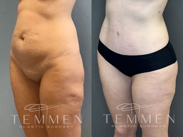 Tummy Tuck Before & After