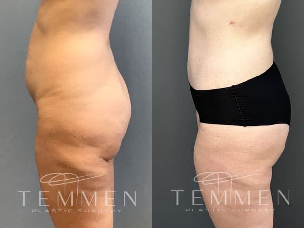 Tummy Tuck Before & After