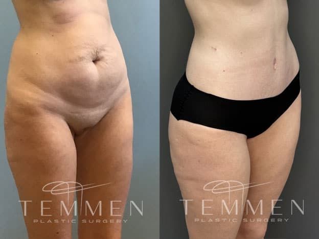 Tummy Tuck Before & After