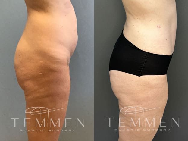 Tummy Tuck Before & After