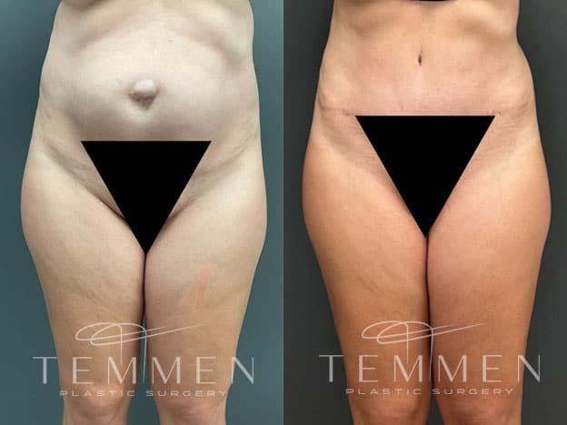 Tummy Tuck Before & After