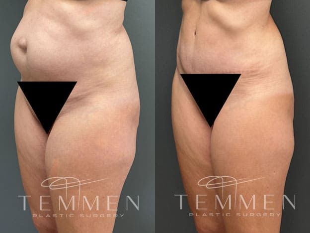 Tummy Tuck Before & After