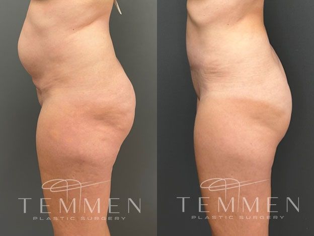 Tummy Tuck Before & After