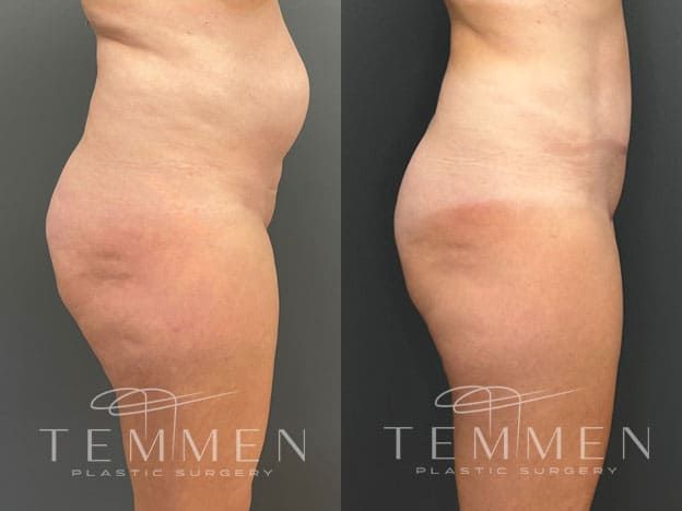 Tummy Tuck Before & After