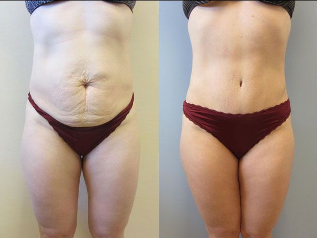 Tummy Tuck Before & After