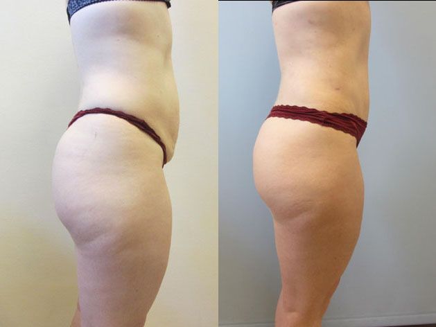 Tummy Tuck Before & After