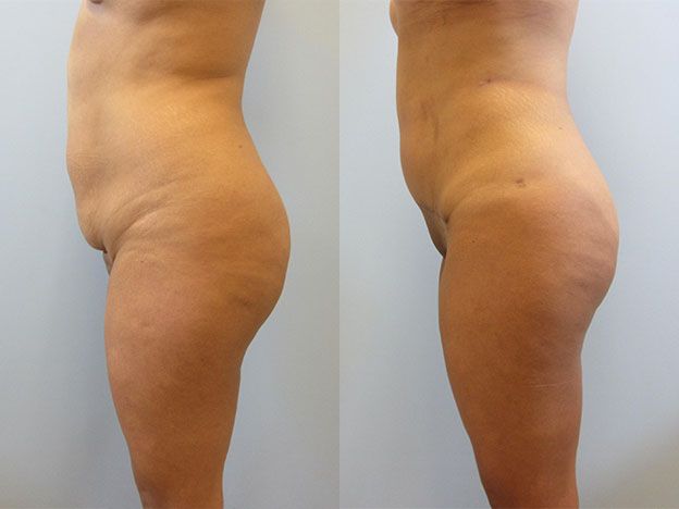 Tummy Tuck Before & After