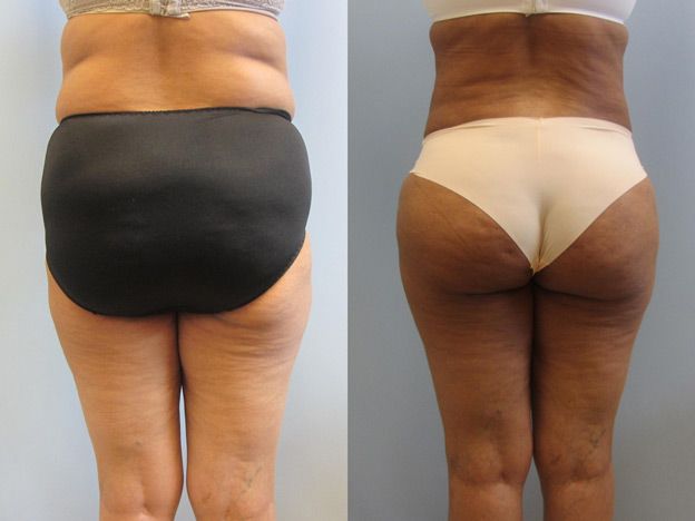 Tummy Tuck Before & After
