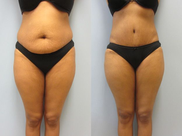 Tummy Tuck Before & After