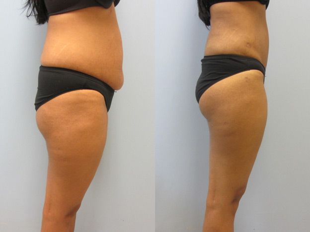 Tummy Tuck Before & After