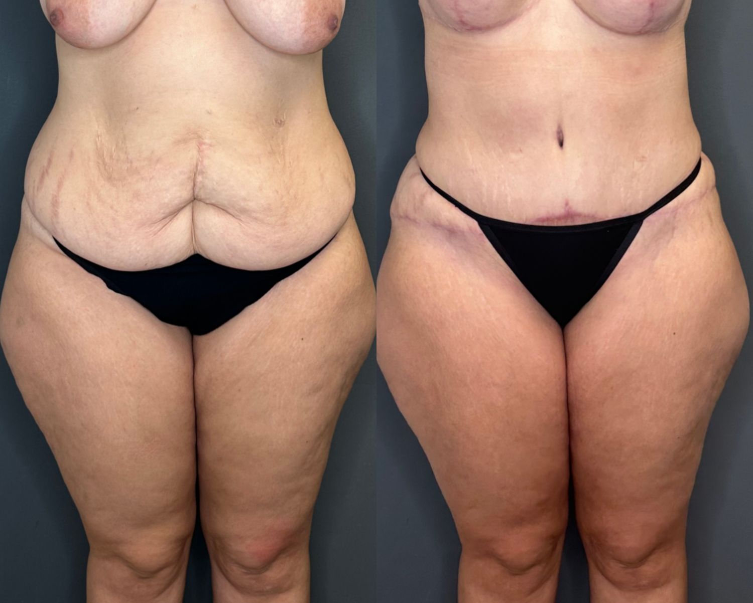 Tummy Tuck Before & After