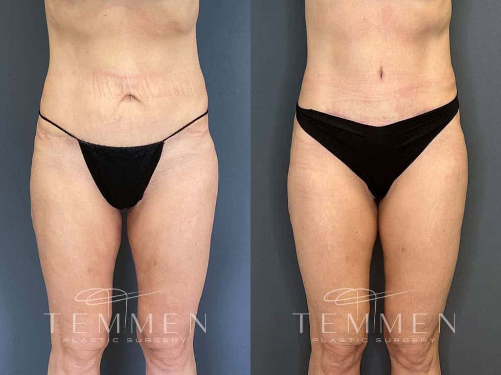 Tummy Tuck Before & After