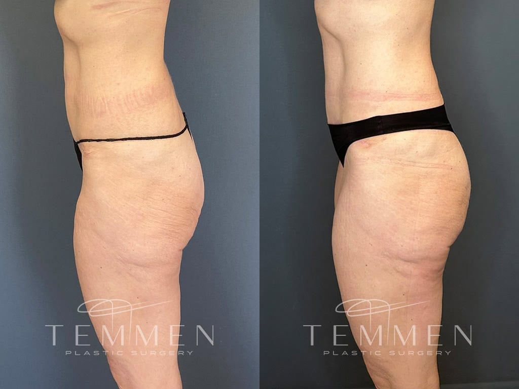 Tummy Tuck Before & After