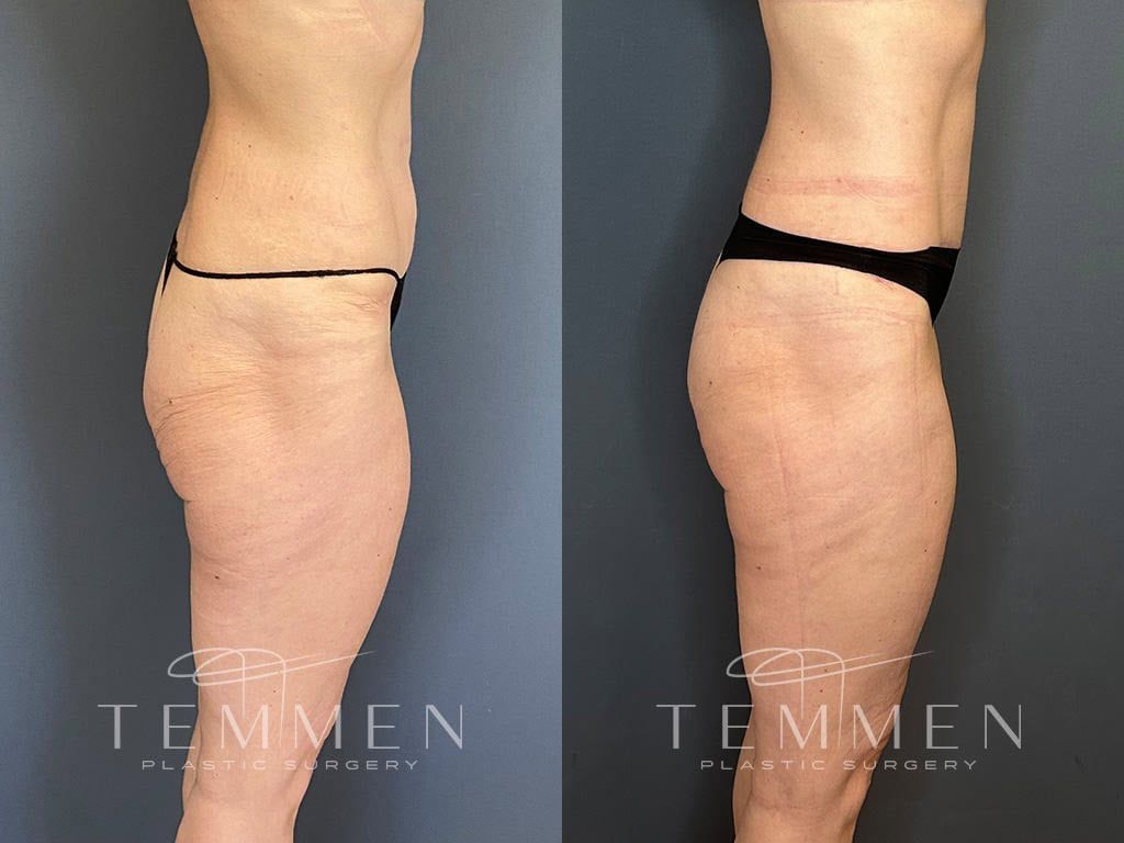 Tummy Tuck Before & After