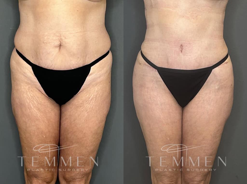 Tummy Tuck Before & After