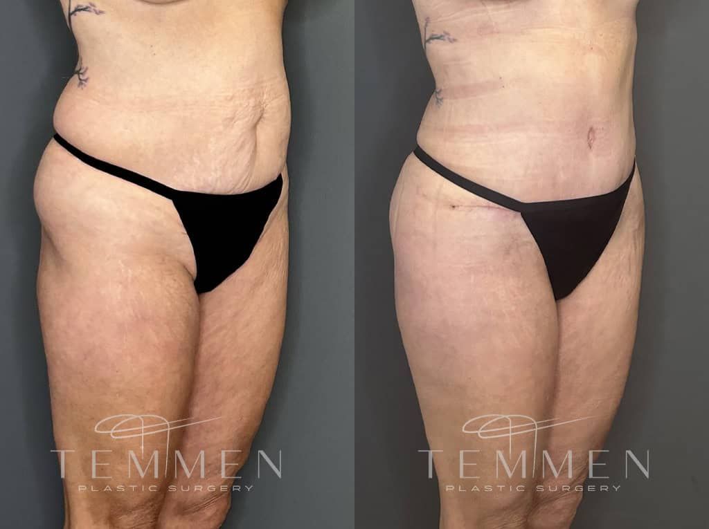 Tummy Tuck Before & After
