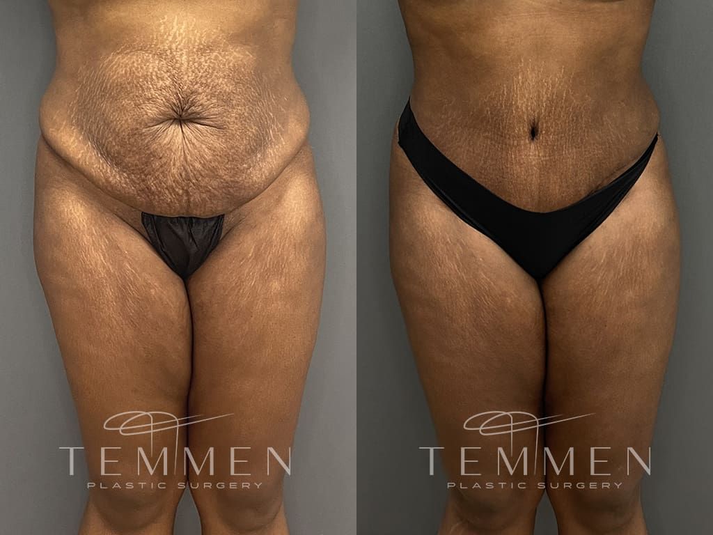Tummy Tuck Before & After