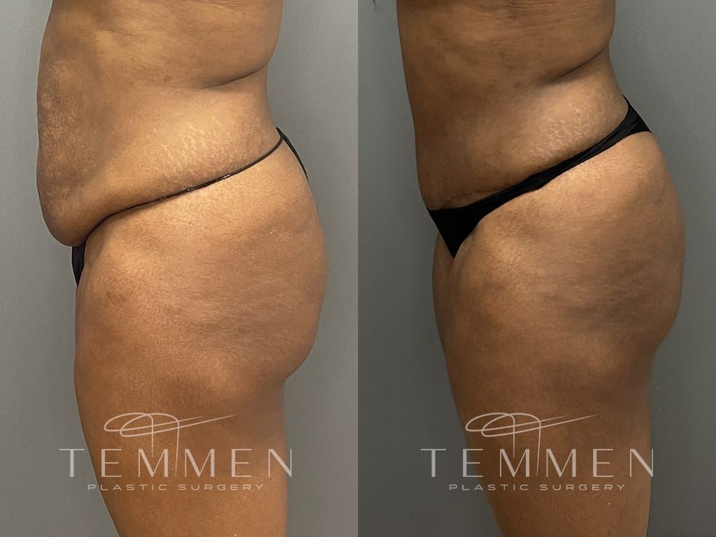 Tummy Tuck Before & After
