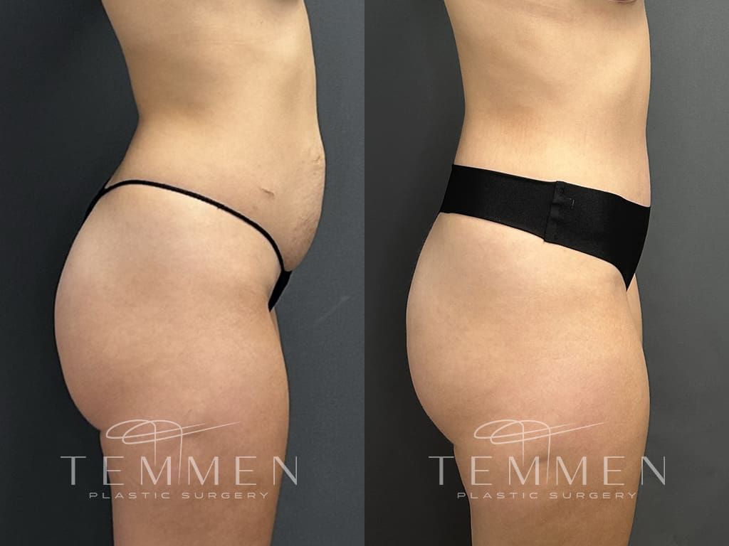 Tummy Tuck Before & After