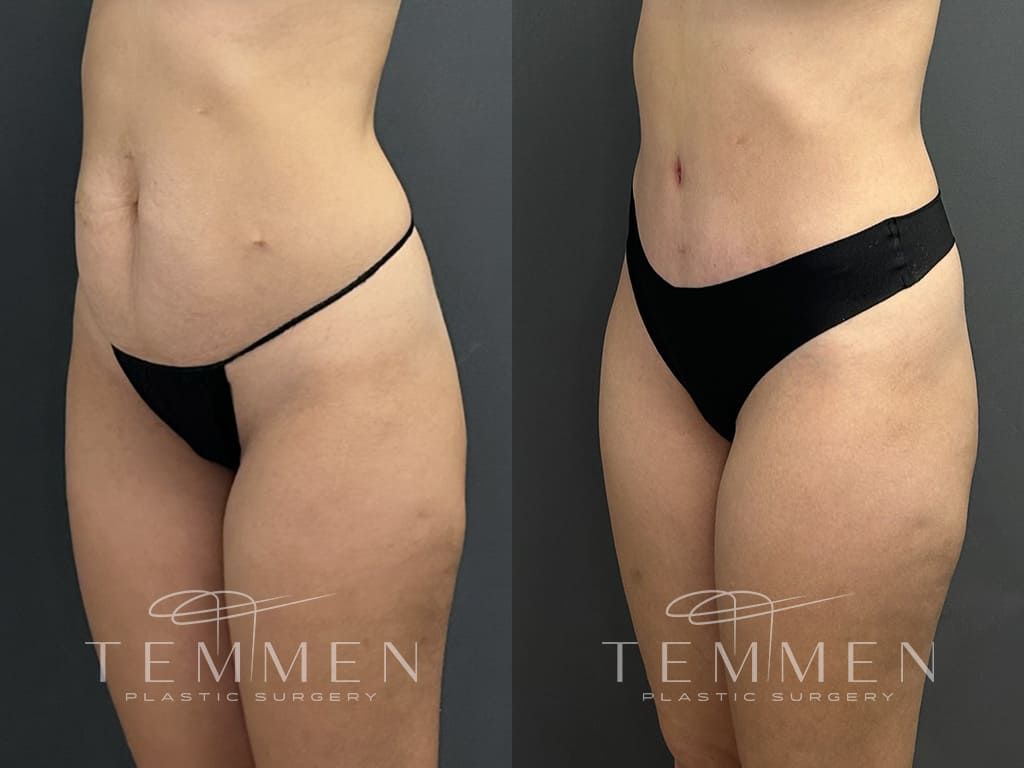 Tummy Tuck Before & After