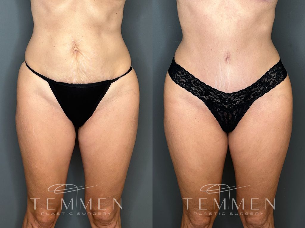 Tummy Tuck Before & After
