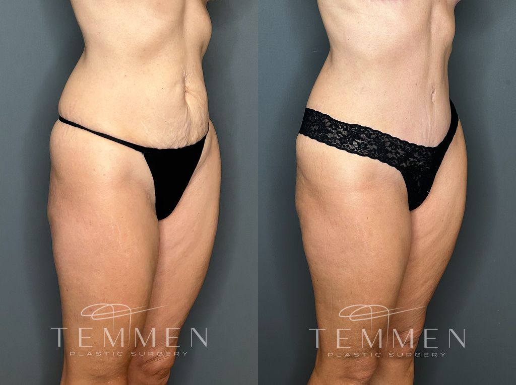 Tummy Tuck Before & After