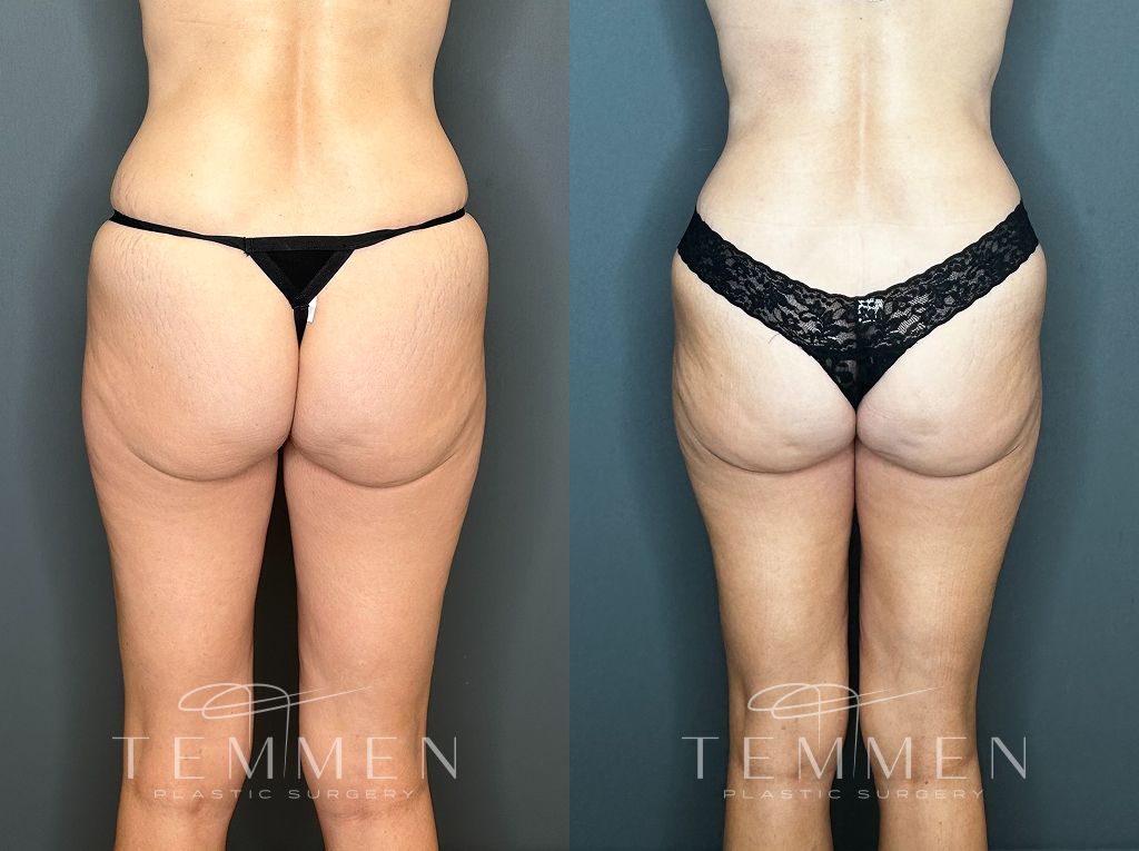 Tummy Tuck Before & After