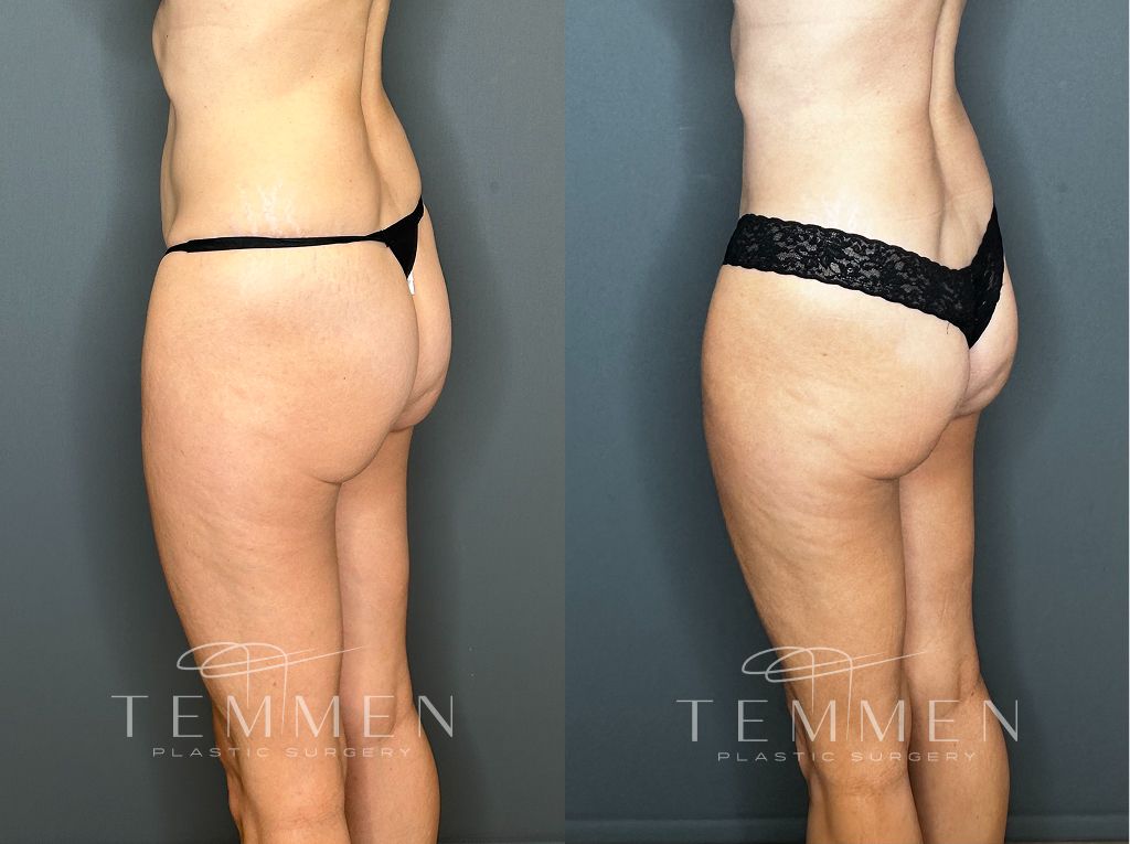 Tummy Tuck Before & After