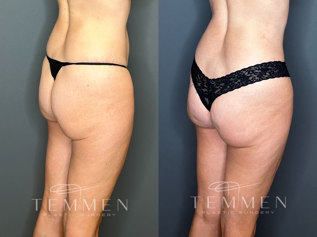 Tummy Tuck Before & After