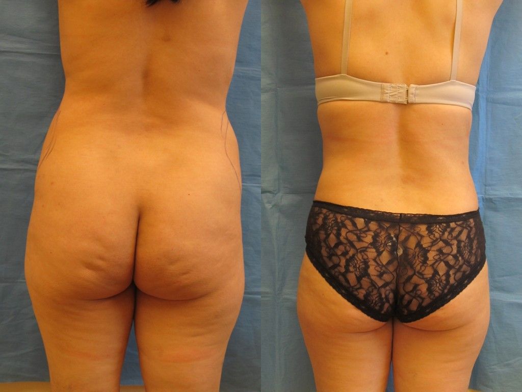 Tummy Tuck Before & After