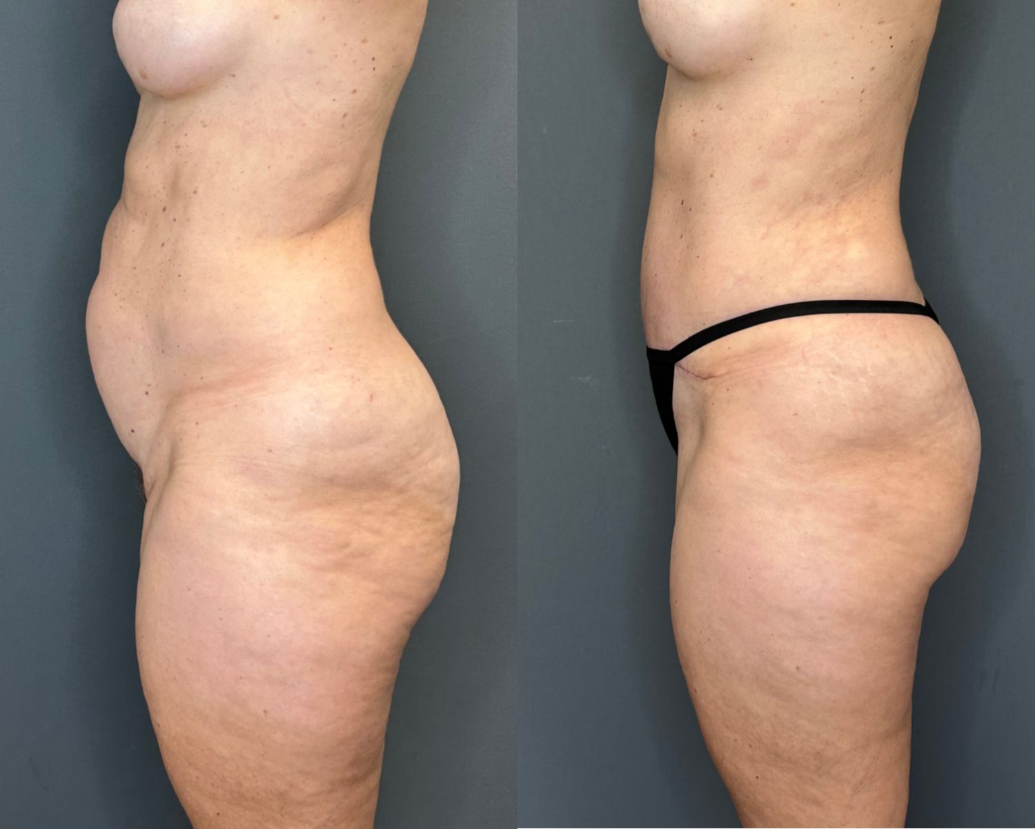 Tummy Tuck Before & After