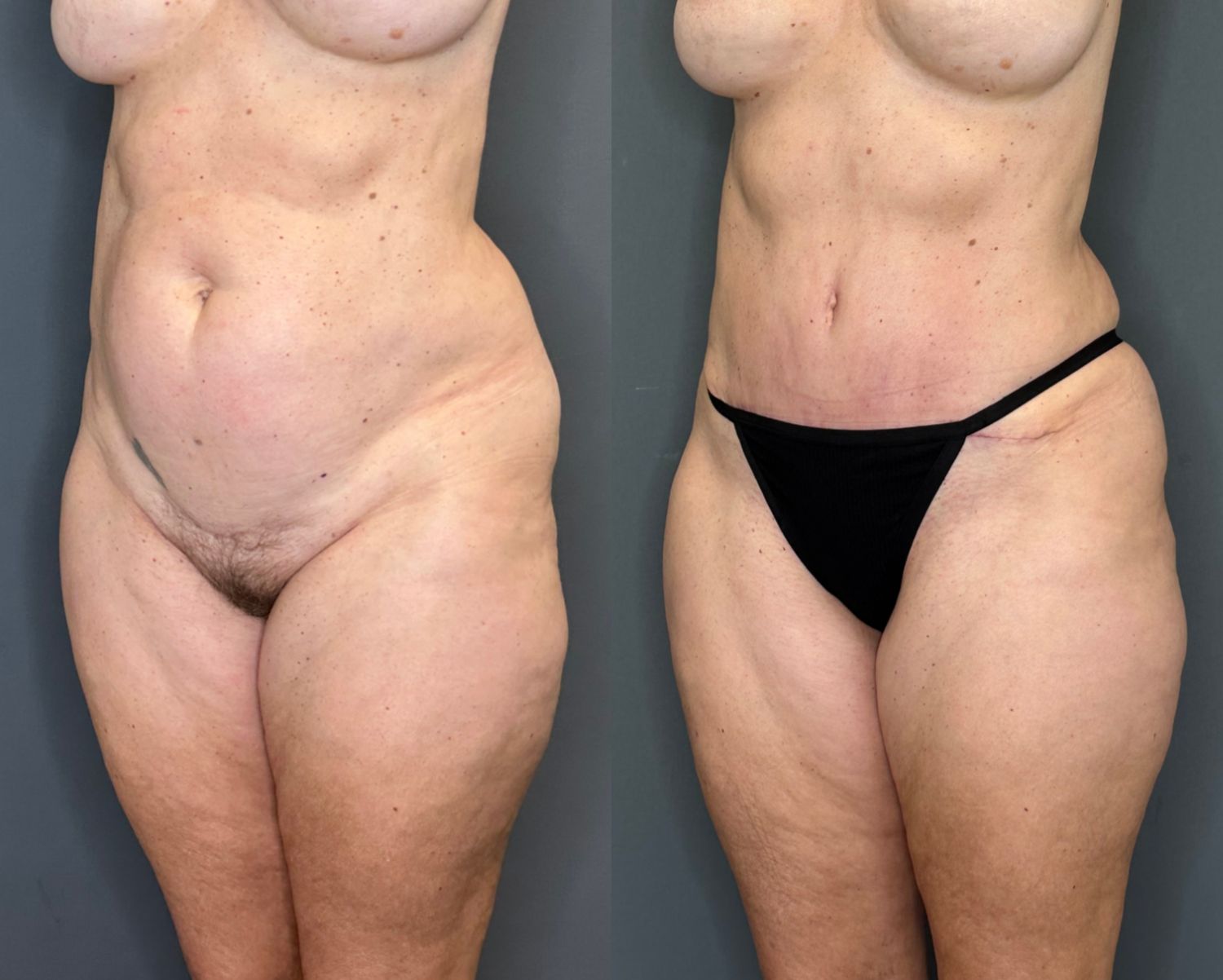 Tummy Tuck Before & After