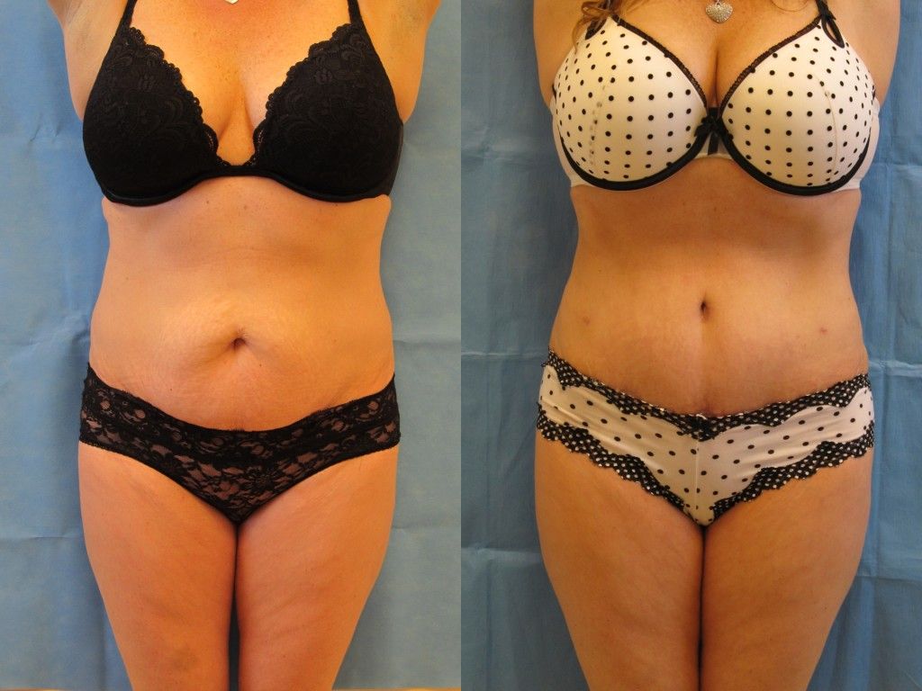 Tummy Tuck Before & After
