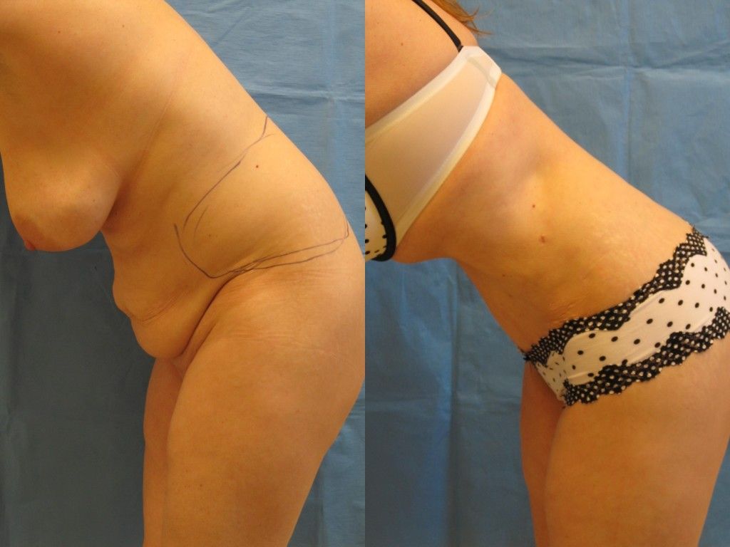 Tummy Tuck Before & After