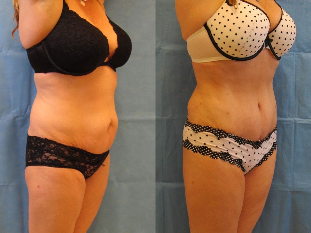 Tummy Tuck Before & After