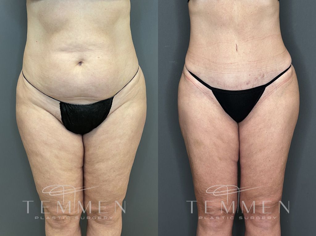 Tummy Tuck Before & After