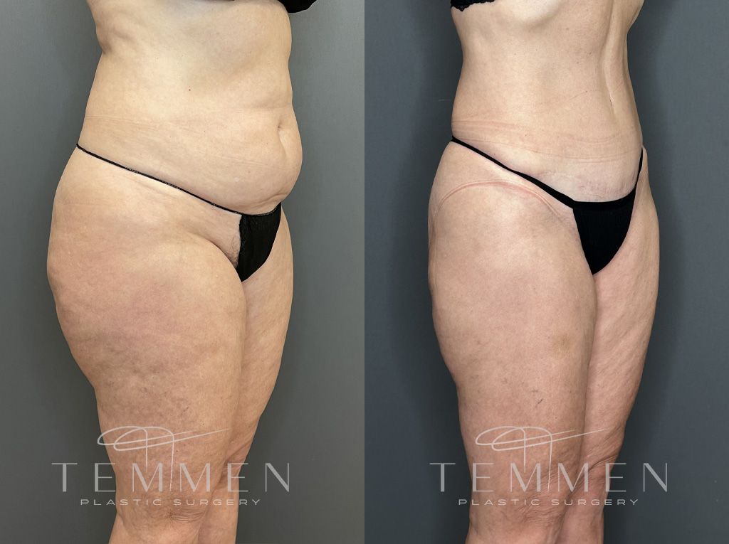 Tummy Tuck Before & After