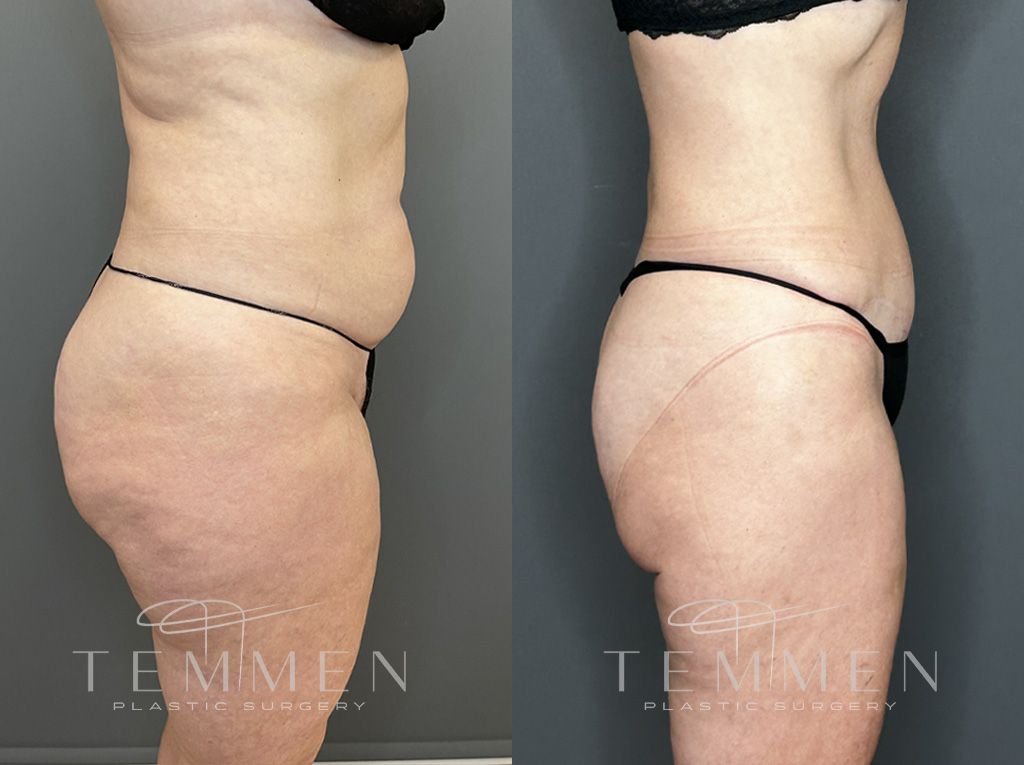 Tummy Tuck Before & After