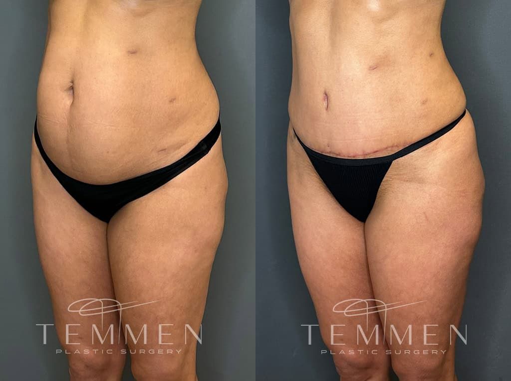 Tummy Tuck Before & After