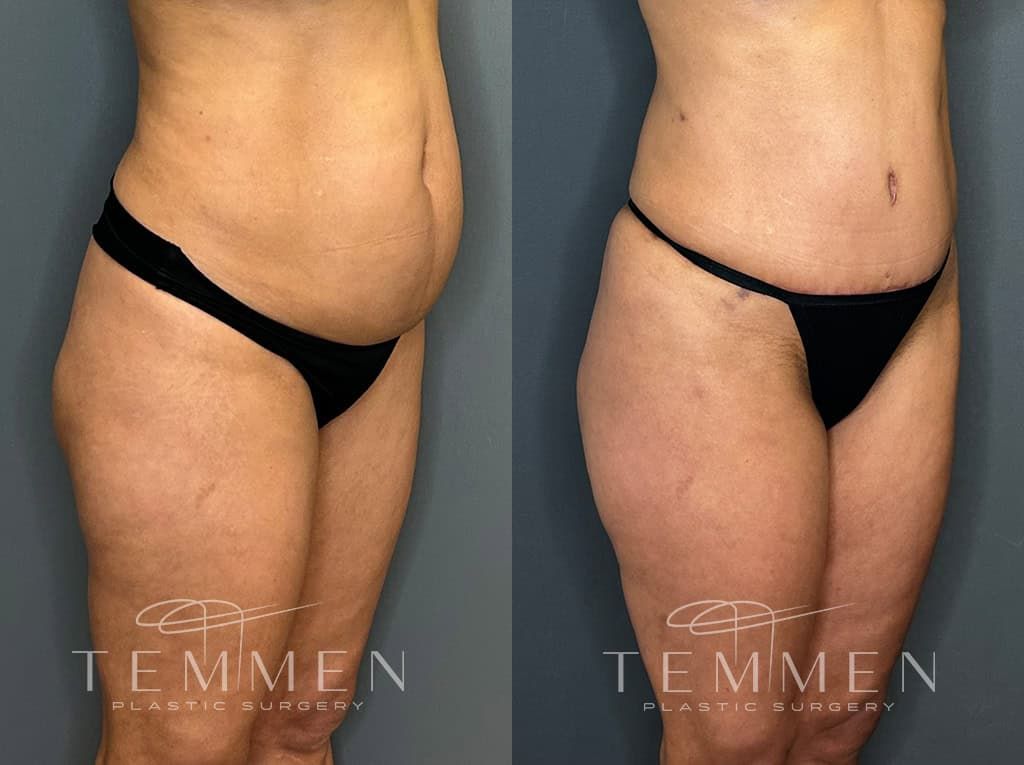 Tummy Tuck Before & After