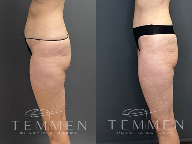 Tummy Tuck Before & After