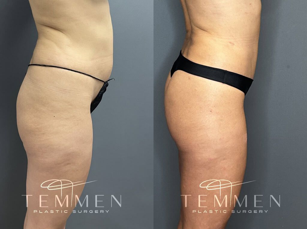 Tummy Tuck Before & After