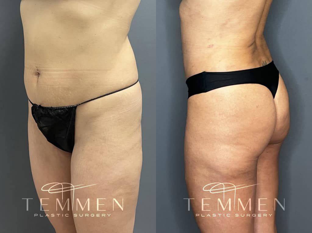 Tummy Tuck Before & After