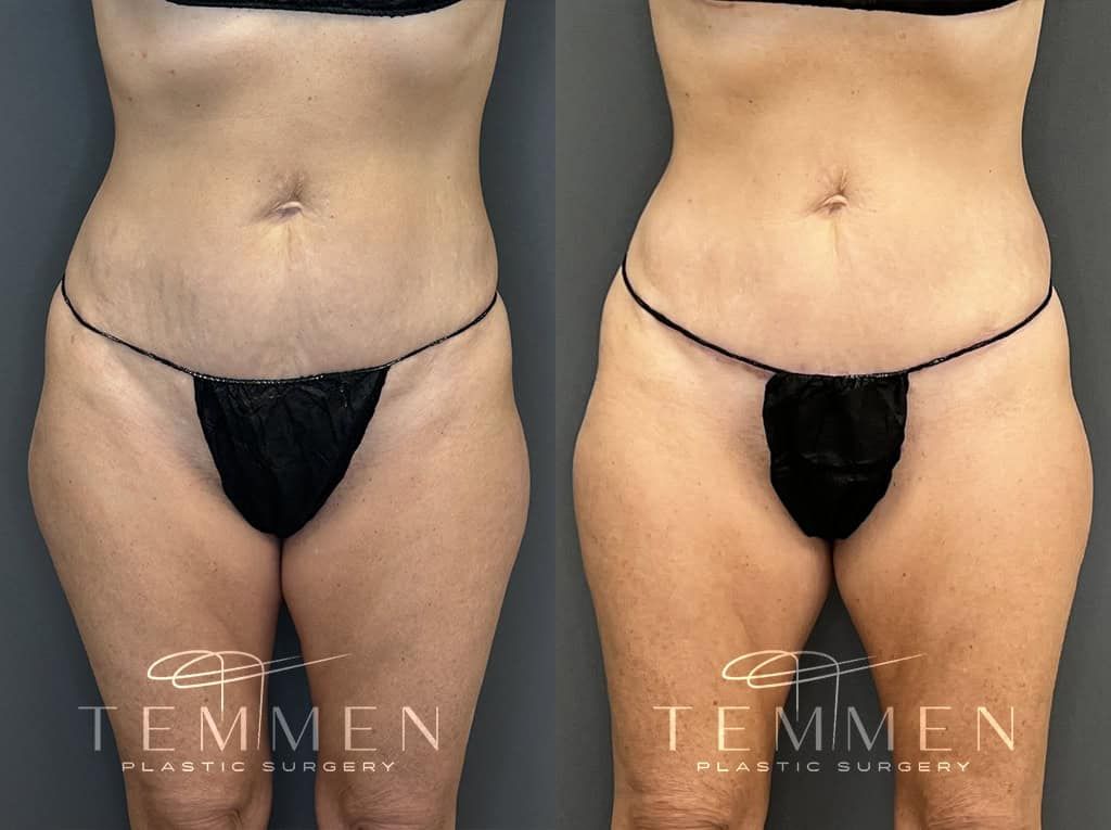 Tummy Tuck Before & After